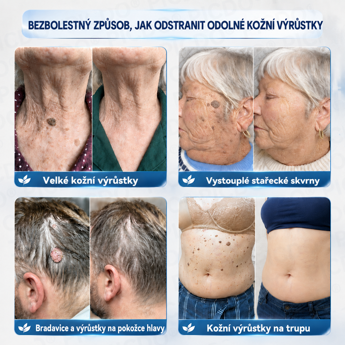 Ximonth® 7‑denní krém k odstraňování kožních výrůstků a pigmentových skvrn 🧴(𝐒𝐜𝐡𝐦𝐞𝐫𝐳𝐟𝐫𝐞𝐢𝐞 𝐅𝐨𝐫𝐦𝐞𝐥 – 𝐨𝐡𝐧𝐞 𝐍𝐚𝐫𝐛𝐞𝐧) 💜