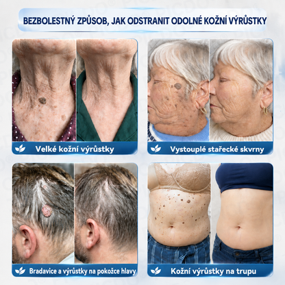 Ximonth® 7‑denní krém k odstraňování kožních výrůstků a pigmentových skvrn 🧴(𝐒𝐜𝐡𝐦𝐞𝐫𝐳𝐟𝐫𝐞𝐢𝐞 𝐅𝐨𝐫𝐦𝐞𝐥 – 𝐨𝐡𝐧𝐞 𝐍𝐚𝐫𝐛𝐞𝐧) 💜