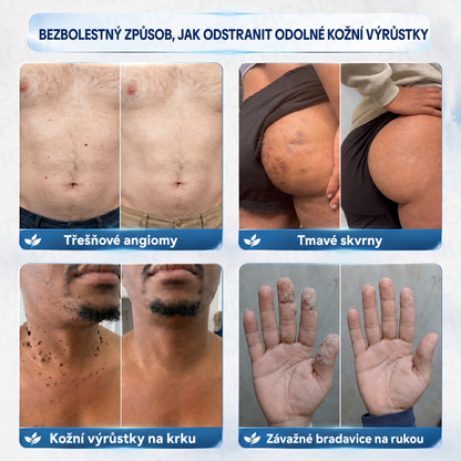 Ximonth® 7‑denní krém k odstraňování kožních výrůstků a pigmentových skvrn 🧴(𝐒𝐜𝐡𝐦𝐞𝐫𝐳𝐟𝐫𝐞𝐢𝐞 𝐅𝐨𝐫𝐦𝐞𝐥 – 𝐨𝐡𝐧𝐞 𝐍𝐚𝐫𝐛𝐞𝐧) 💜