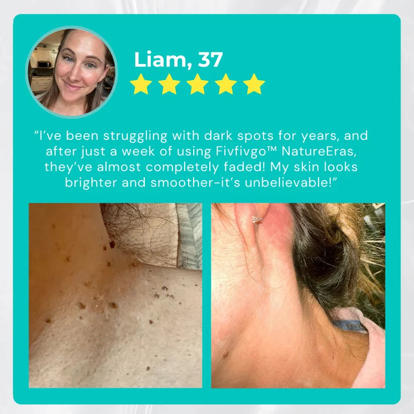 ✅ Oficjalny sklep: Fivfivgo™ NatureErase Instant Mole & Spot Cream