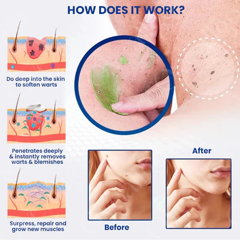 ✅ Oficjalny sklep: Fivfivgo™ NatureErase Instant Mole & Spot Cream