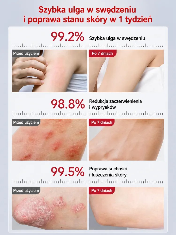 【Specjalizacja w leczeniu uporczywego zapalenia skóry】Kojący krem pielęgnacyjny do skóry